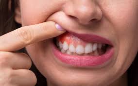 Why Gum Disease Shouldn't Be Ignored (and What to Do Instead)