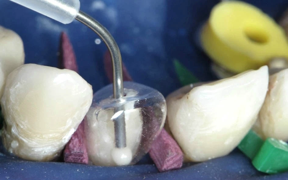 Dental tool being used on a model of teeth with a blue background