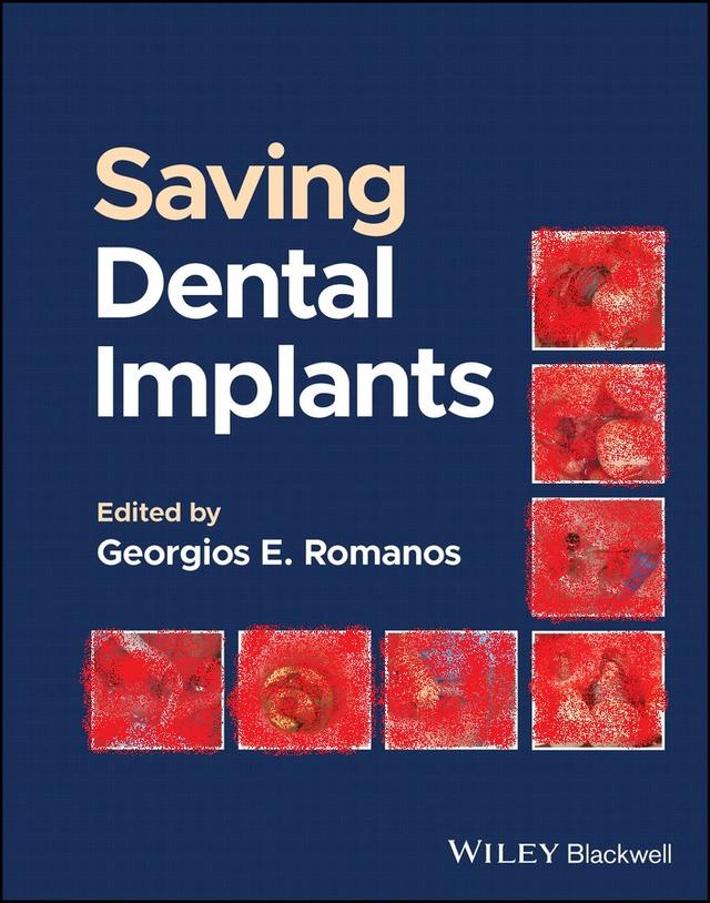 Saving Dental Implants 2024