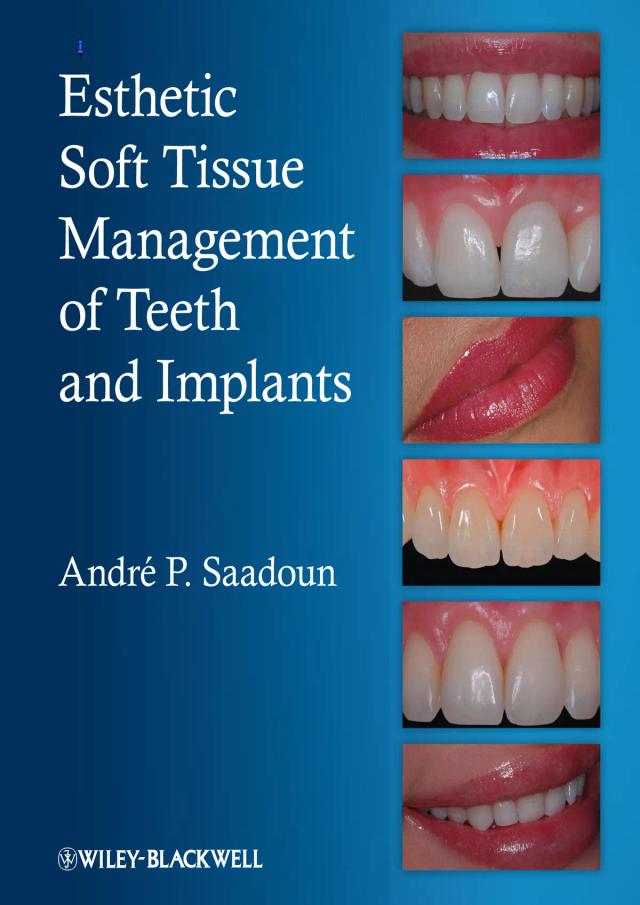 Esthetic Soft Tissue Management of Teeth and Implant 2013