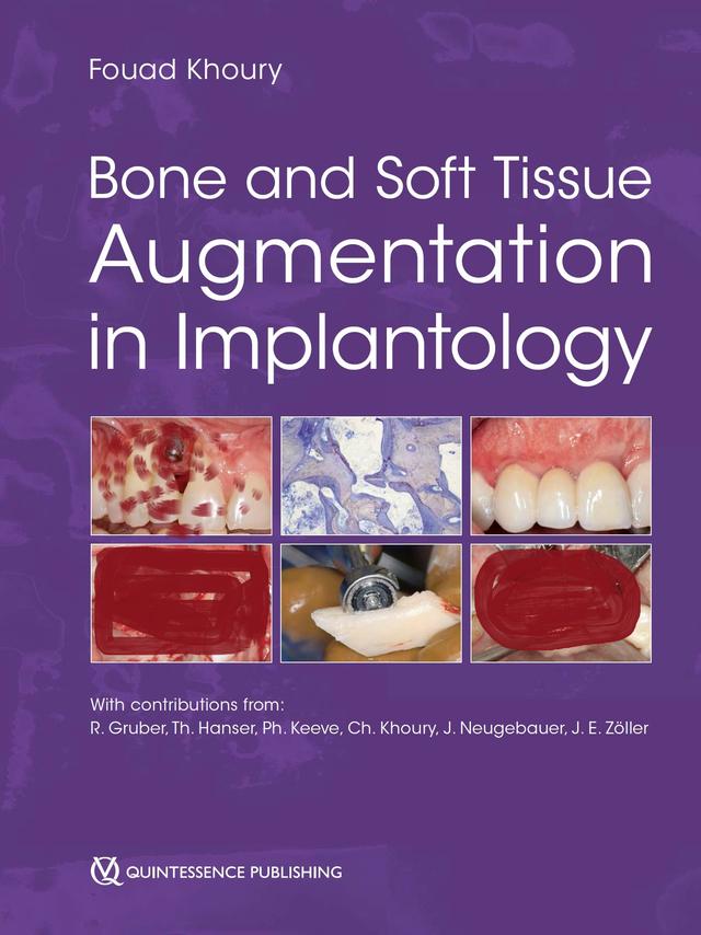 Bone and Soft Tissue Augmentation in Implantology 2022