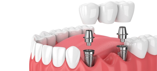 dental implant prosthetic screws implant dentistry
