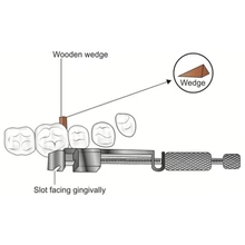 Universal Tofflemire matrix band retainer instrument used to secure matrix bands during posterior restorations