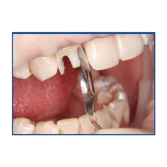 Close-up of a dental procedure with a dental tool on teeth.