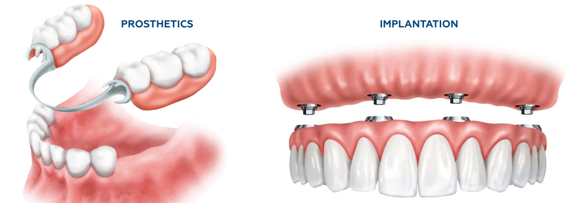 Diagram comparing dental prosthetics and implantation with labeled parts.