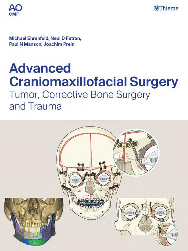 Advanced Craniomaxillofacial Surgery Tumor, Corrective Bone Surgery and Trauma 2020