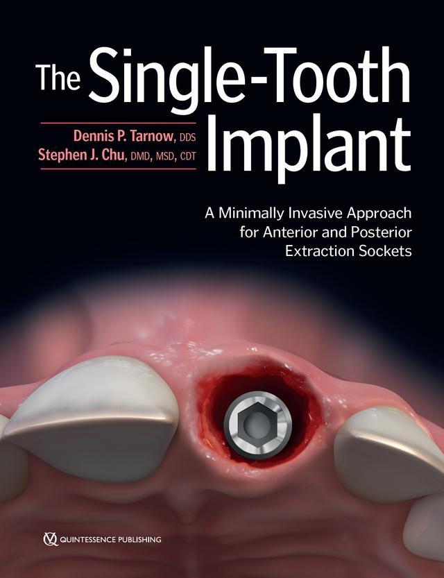 The Single-Tooth Implant A Minimally Invasive Approach for Anterior and Posterior Extraction Sockets 2020