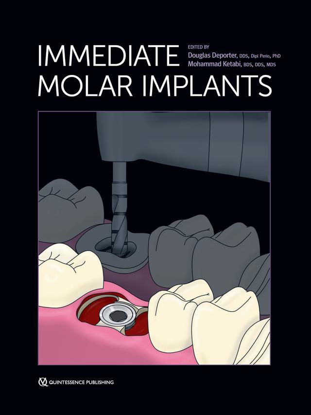 Immediate Molar Implants 2023