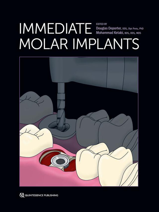 Immediate Molar Implants 2023
