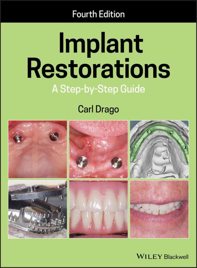 Implant Restorations A Step-by-Step Guide 2020