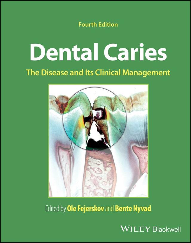 Dental Caries The Disease and Its Clinical Management 2025