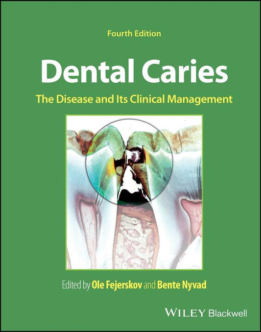 Dental Caries The Disease and Its Clinical Management 2025