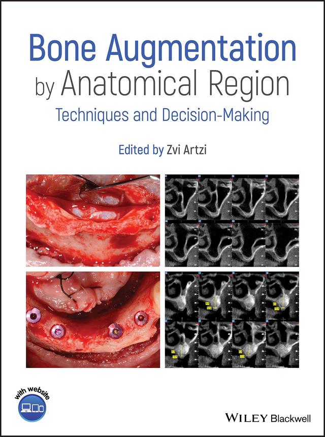 Bone Augmentation by Anatomical Region 2020