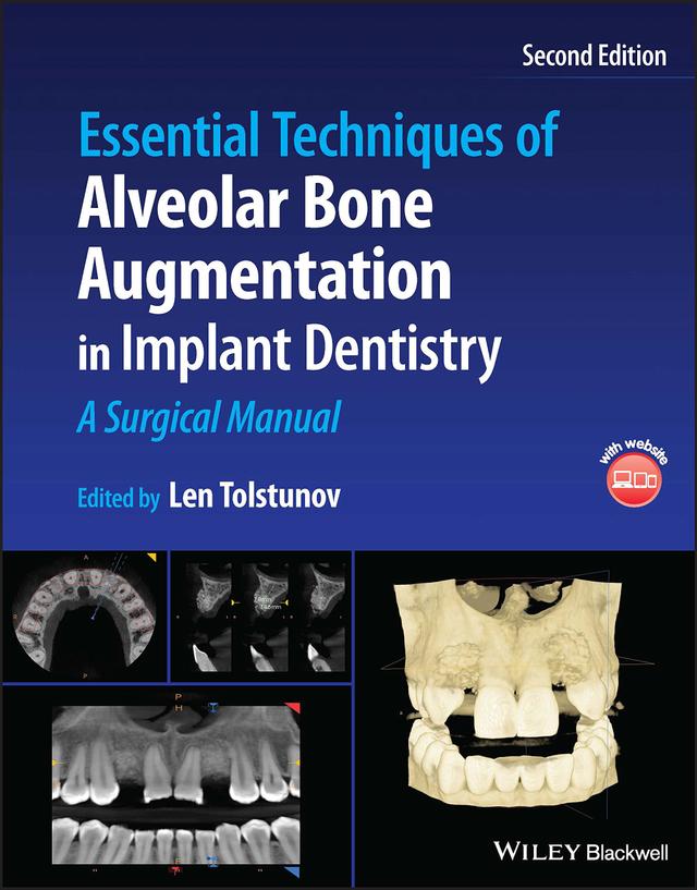 Essential Techniques of Alveolar Bone Augmentation in Implant Dentistry 2023