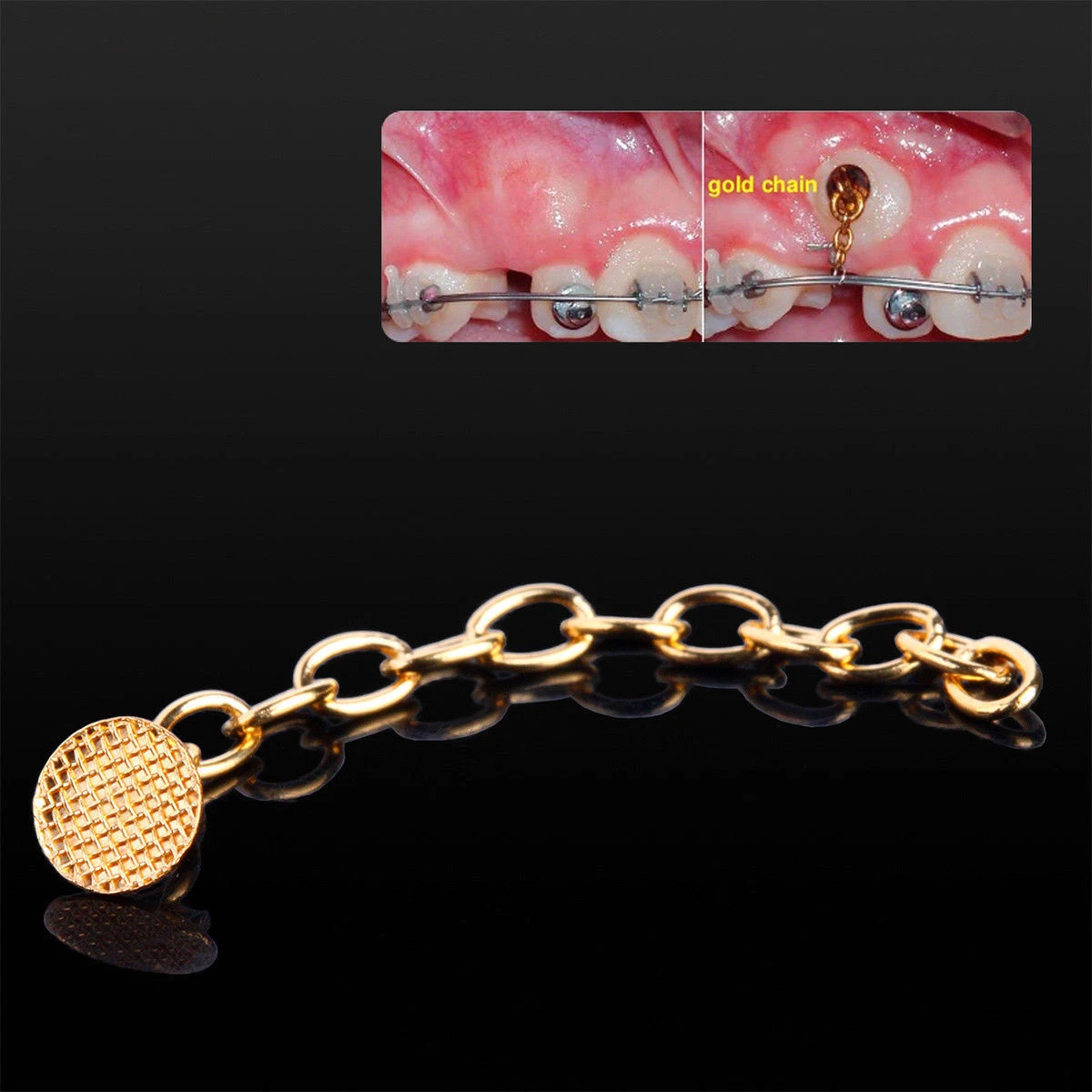 Orthodontic Lingual Button with Gold Traction Chain for Impacted Teeth