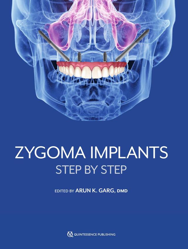 Zygoma Implants Step by Step 2023